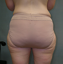 Body Liposculpture Before and After Photos