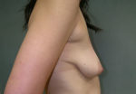 Mastopexy Augmentation