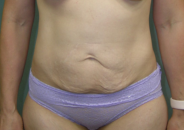 Tummy Tuck Before and After Photos