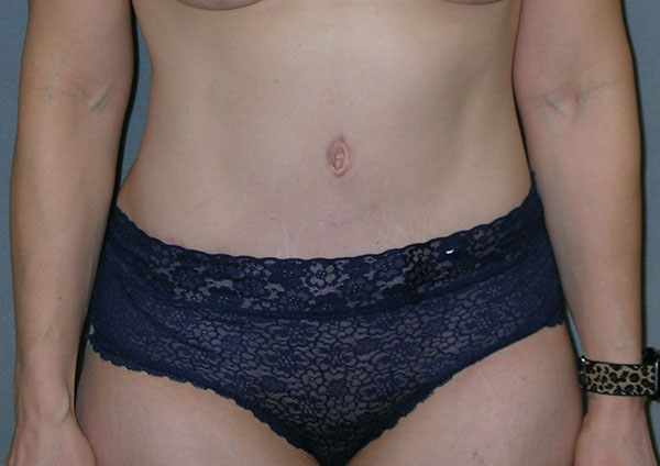 Tummy Tuck Before and After Photos