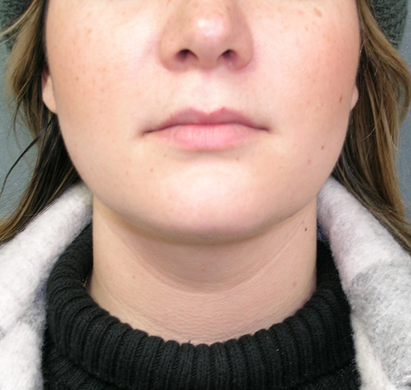 Facial Liposculpture Before and After Photos | Dr. Balakhani