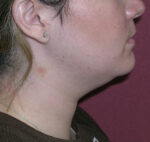 Facial Liposculpture