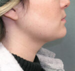 Facial Liposculpture