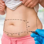 What to Expect During Your Tummy Tuck Consultation