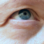 Why Eyelids Sag With Age and the Most Effective Ways to Treat It