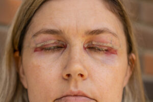 480 F 522985088 uCbda31neG1BN32YaNmF2CKs8HWDdTmP Eyelid Surgery Recoervy in Newark, DE