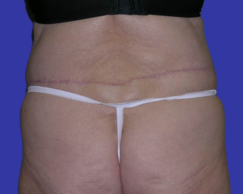 Back View belt lipectomy after photo by Dr. Balakhani