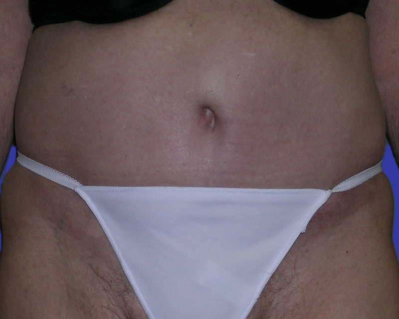 Front View belt lipectomy after photo by Dr. Balakhani