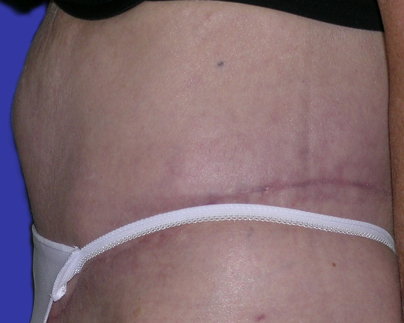Left Side View belt lipectomy after photo by Dr. Balakhani