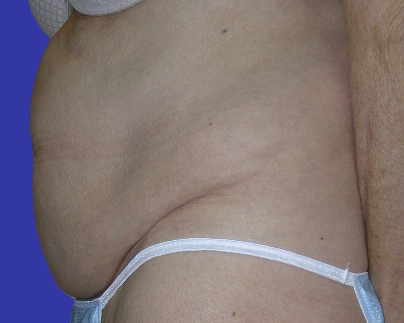 Left Side View belt lipectomy before photo by Dr. Balakhani