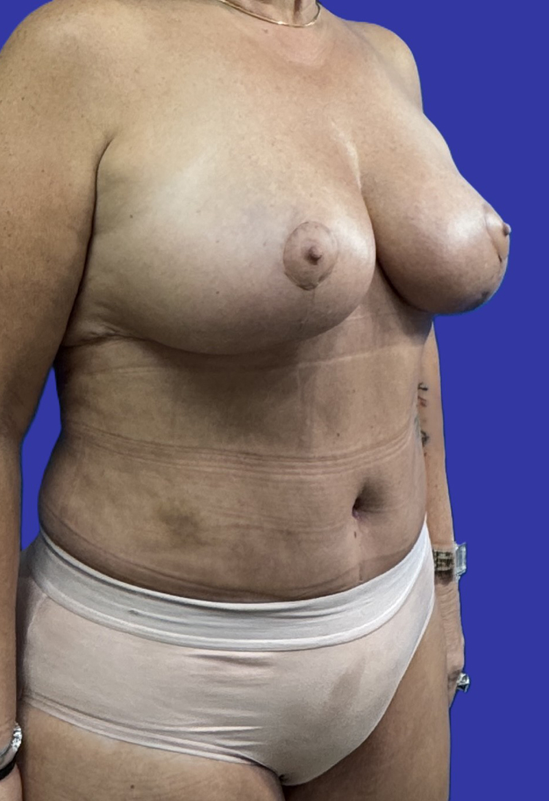 Right Oblique View Mommy Makeover, Tummy Tuck & Breast Lift after photo by Dr. Balakhani