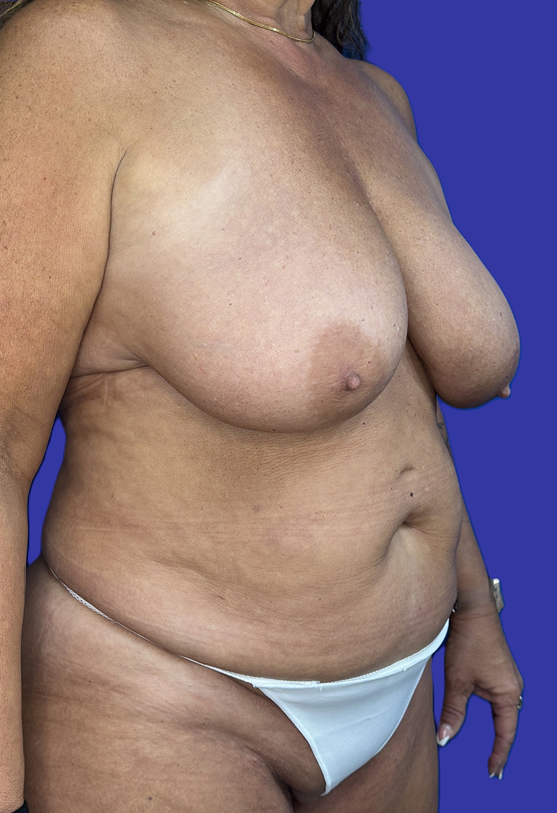 Right Oblique View Mommy Makeover, Tummy Tuck & Breast Lift before photo by Dr. Balakhani