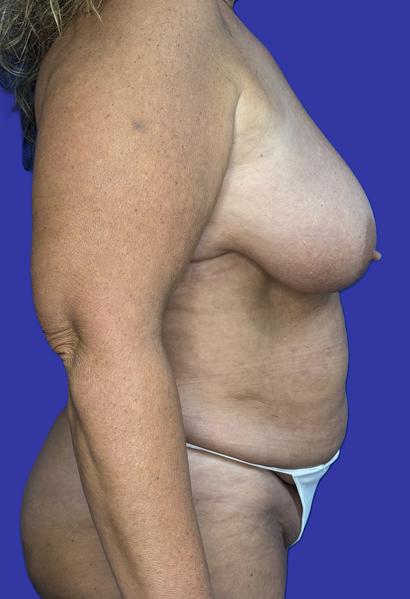 Right Side View Mommy Makeover, Tummy Tuck & Breast Lift before photo by Dr. Balakhani