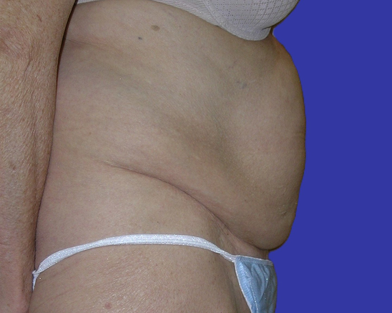 Right Side View belt lipectomy before photo by Dr. Balakhani
