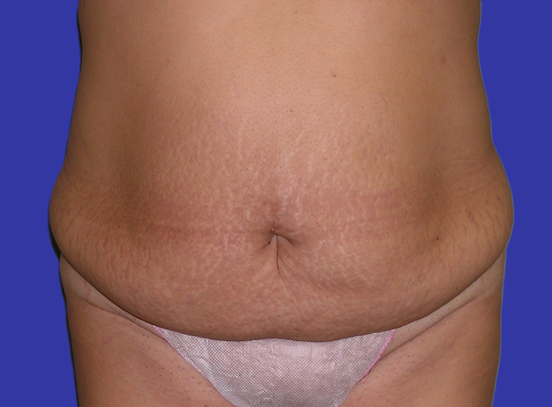 Front View abdominoplasty and liposuction before photo by Dr. Balakhani