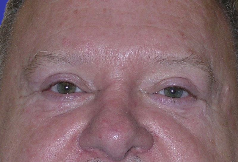 Front View upper and lower blepharoplasty after photo by Dr. Balakhani