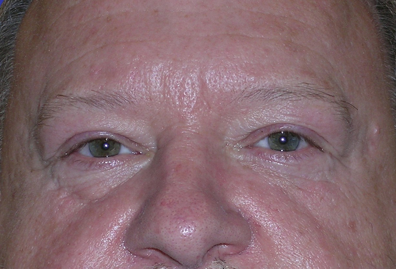 Front View upper and lower blepharoplasty before photo by Dr. Balakhani