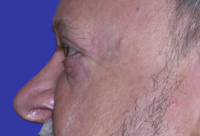 Left Side View upper and lower blepharoplasty after photo by Dr. Balakhani