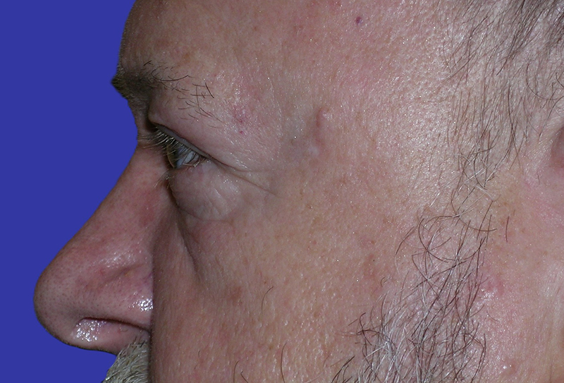 Left Side View upper and lower blepharoplasty before photo by Dr. Balakhani
