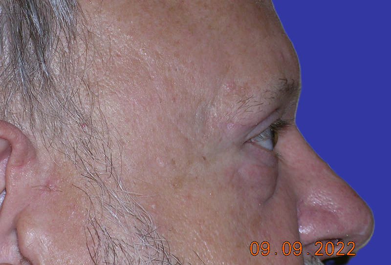 Right Side View upper and lower blepharoplasty after photo by Dr. Balakhani