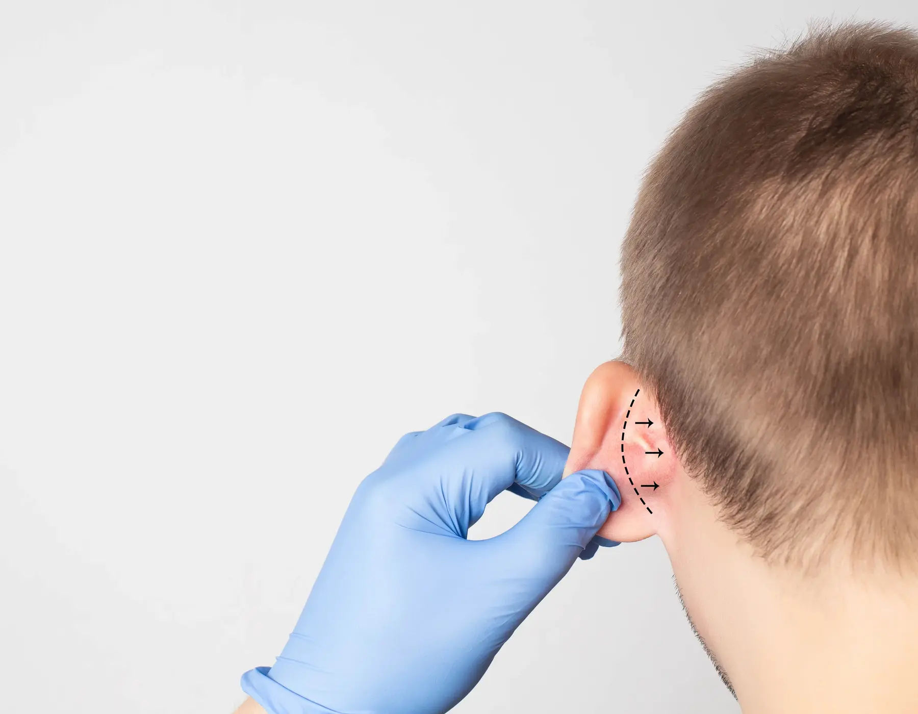 Otoplasty in Newark and New Castle County, DE 6 Surgeon marks patient's ear with dotted lines for cosmetic ear procedure.