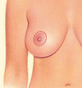 Around the Areola, Incision