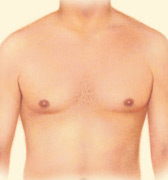 Liposuction, Outline