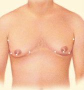 Liposuction, Incision