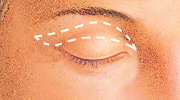 Eyelid Surgery, Outline