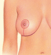 Breast Reduction - Vertical Incision, After