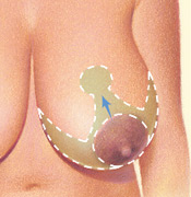 Breast Reduction - Anchor Shaped Incision, Before