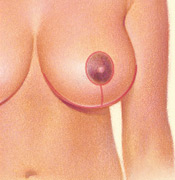 Breast Reduction - Anchor Shaped Incision, After