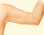 Arm Lift, Incision