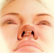 Nose Surgery, Outline