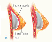 Inserting Breast Implants