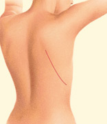 Latissimus Dorsi Flap, Incision Delaware