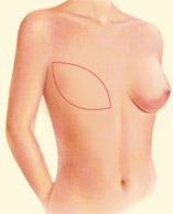 Complete Breast Mound, Incision